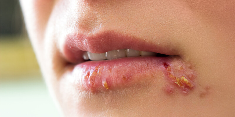 Image representing symptoms of the Herpes Simplex Virus